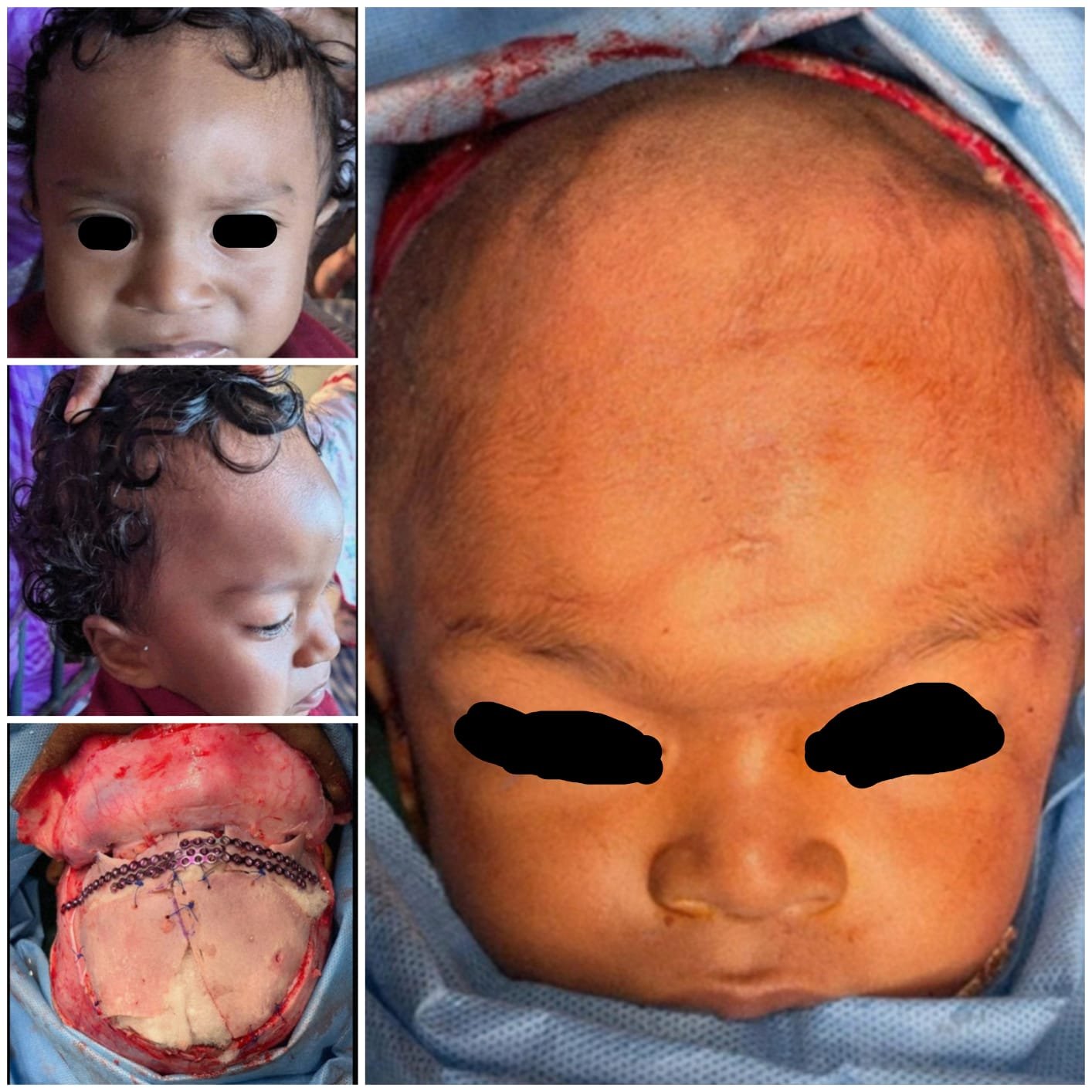 craniofacial surgery -Trigonocephaly correction